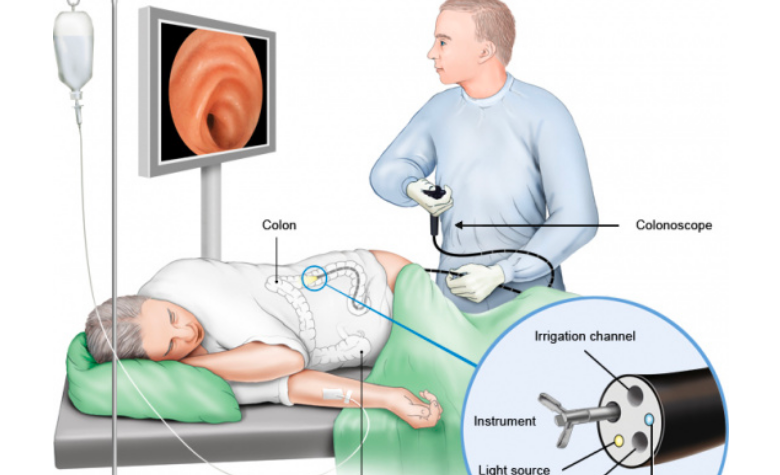 Колоноскопия какой. Эндоскопическое исследование Толстого кишечника. УЗИ кишечника колоноскопия. Колоноскопия схема проведения.