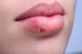 Лихорадка на губах: народные средства